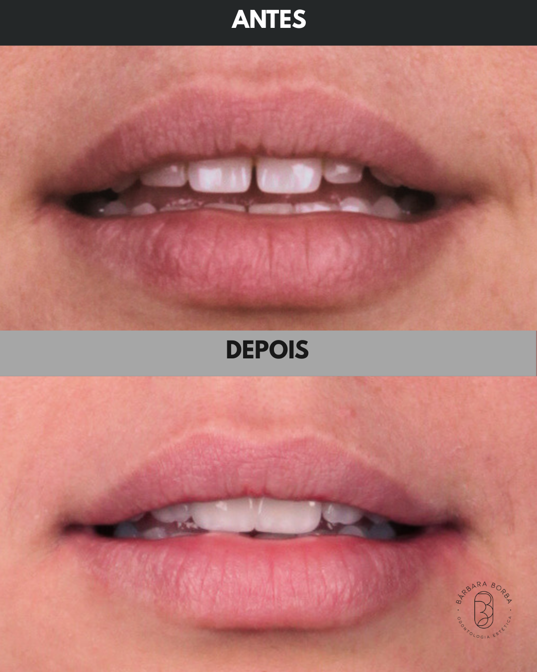 Antes e Depois - 05